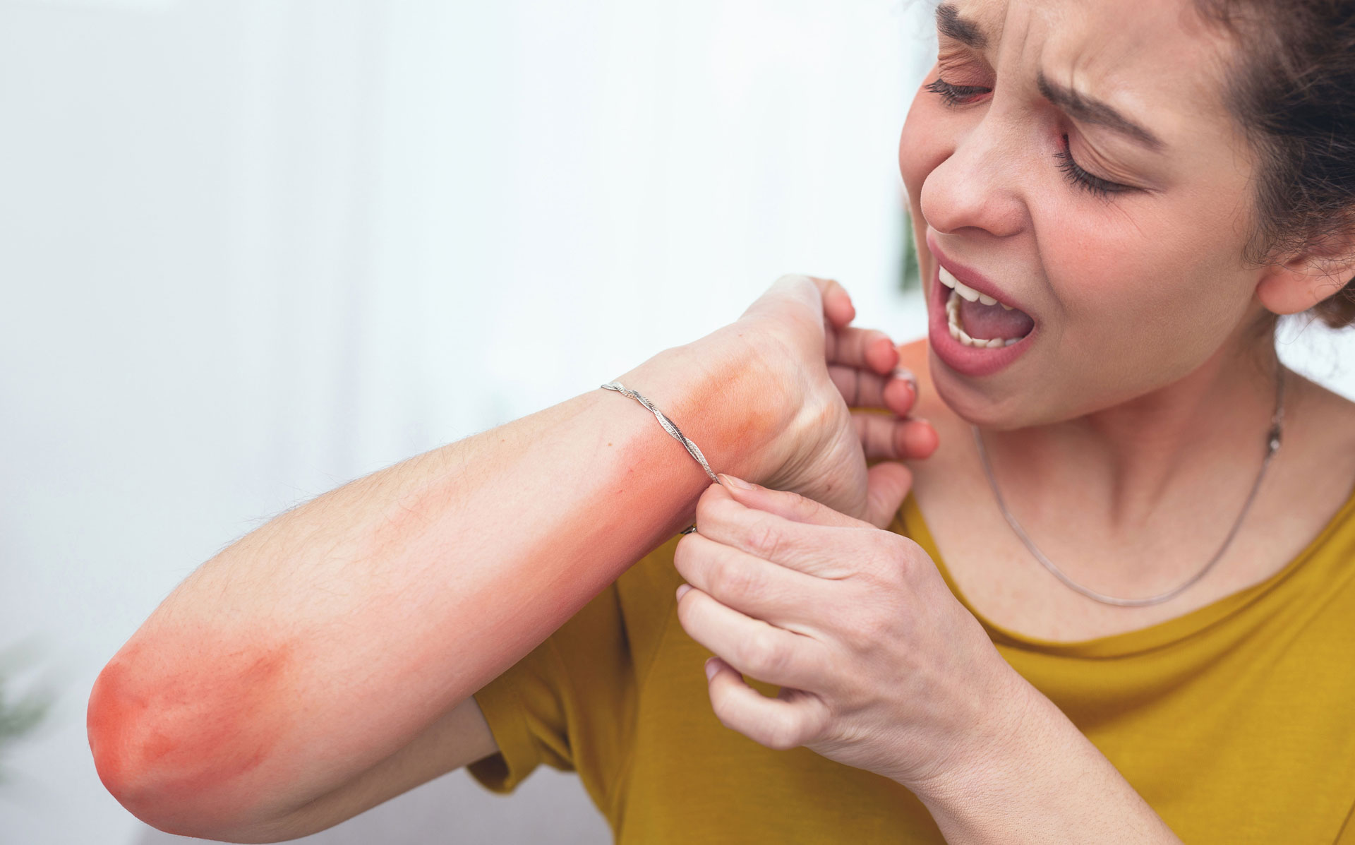 Typ-IV-Allergie: Hautreaktion am Arm Frau mit starker Hautrötung am Unterarm als mögliche Typ-IV-Allergie, während sie ein Armband entfernt.